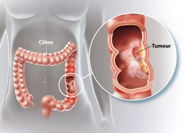 CANCER COLORECTAL