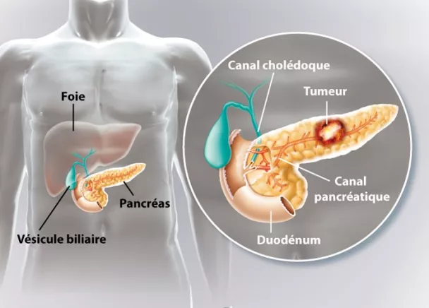 cancer du pancreas